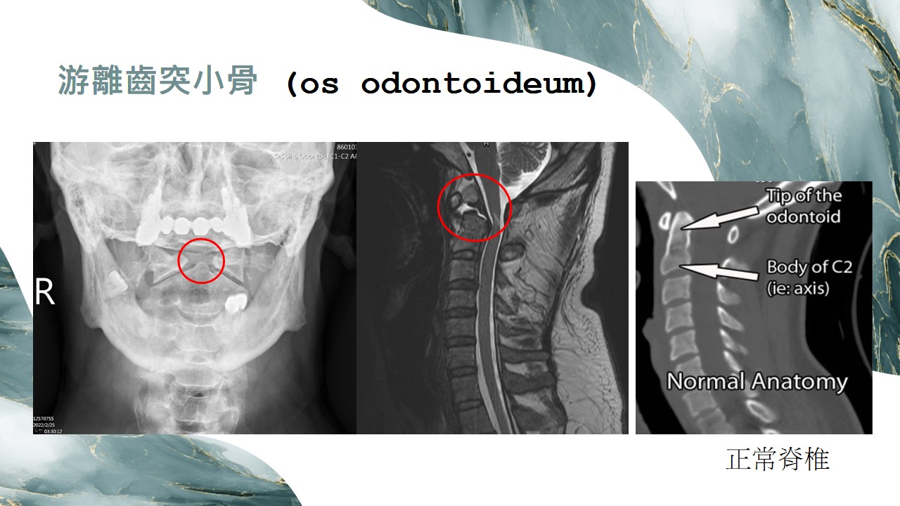Os odontoideum B 示意圖